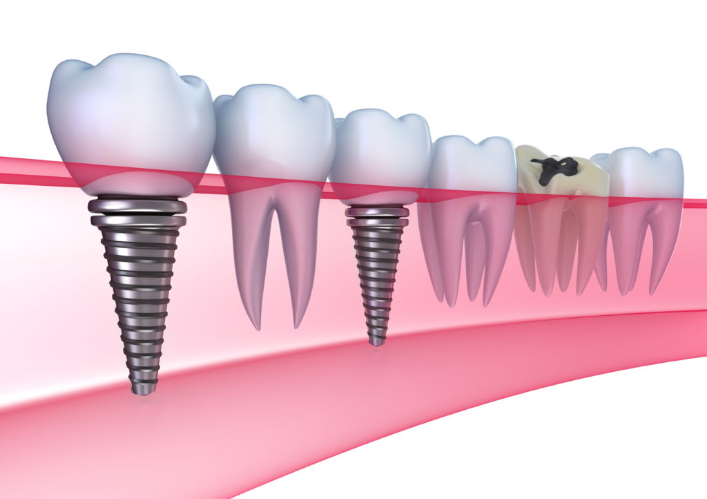 long island dental implants