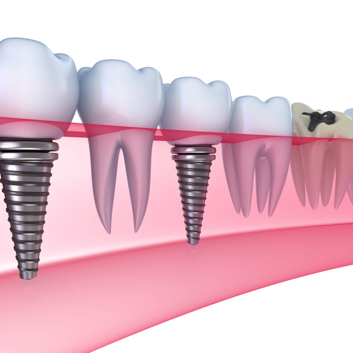 Dental Implants