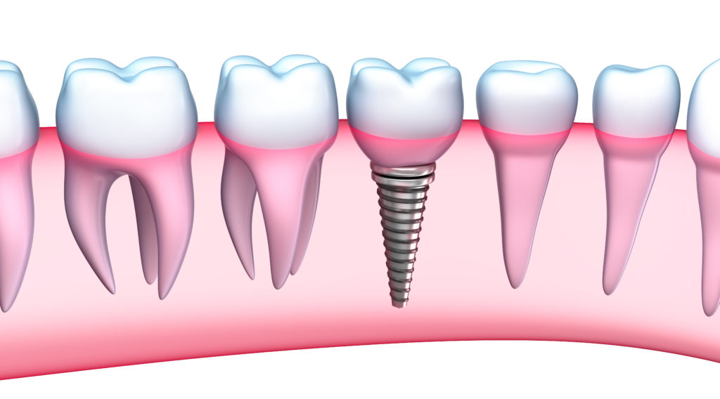 long island implant dentistry suffolk county