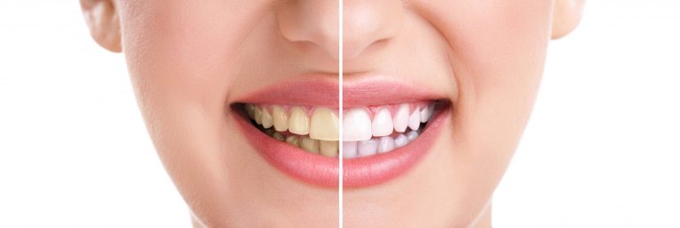 Teeth Whitening Long Island Suffolk County Sachem