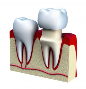 suffolk county dental crown