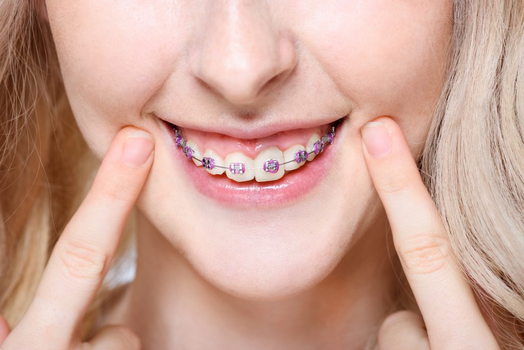 Q&M Braces, Types of Braces, Straighten teeth, Invisible braces, Speech  improvement