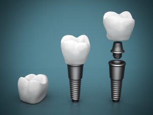 implant supported dentures