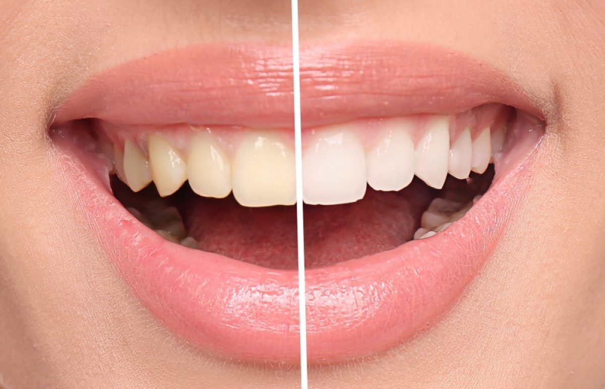 patchogue zoom teeth whitening dentists