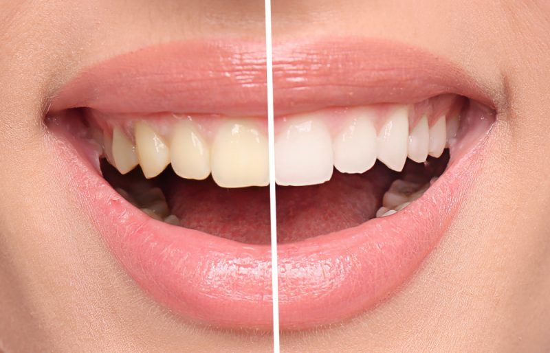 InOffice Teeth Whitening Sachem Dental Group