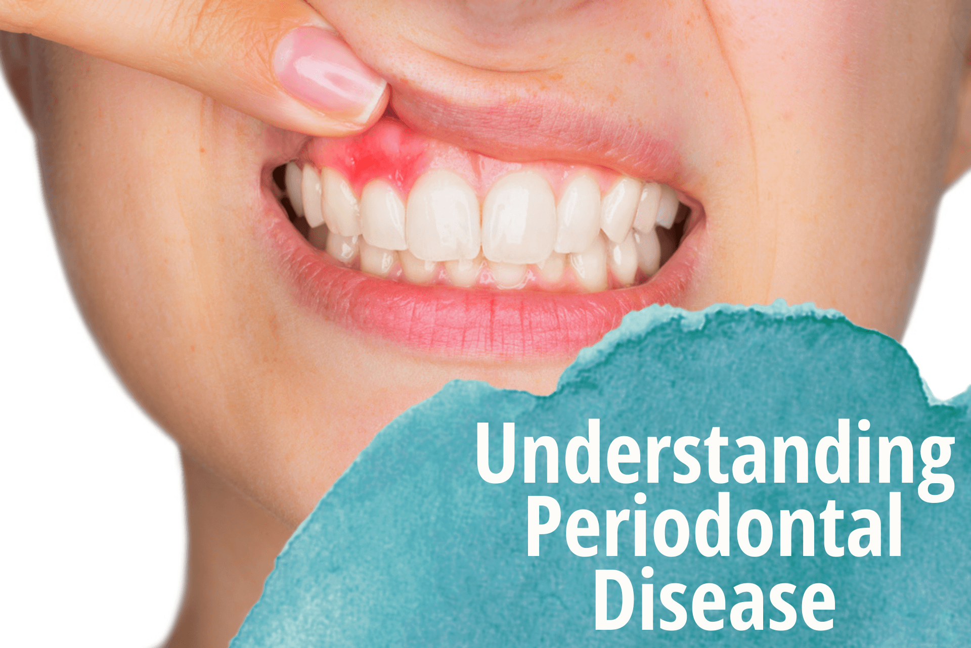 4 Steps Involved In Periodontitis Therapy