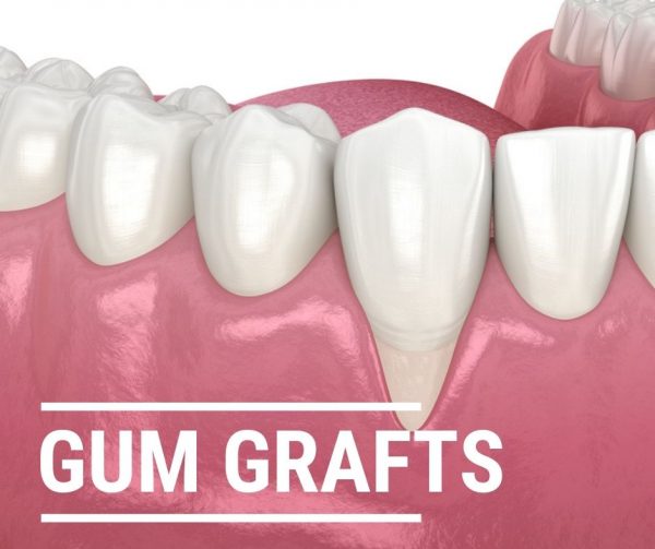 Soft Tissue Grafting Sachem Dental Group