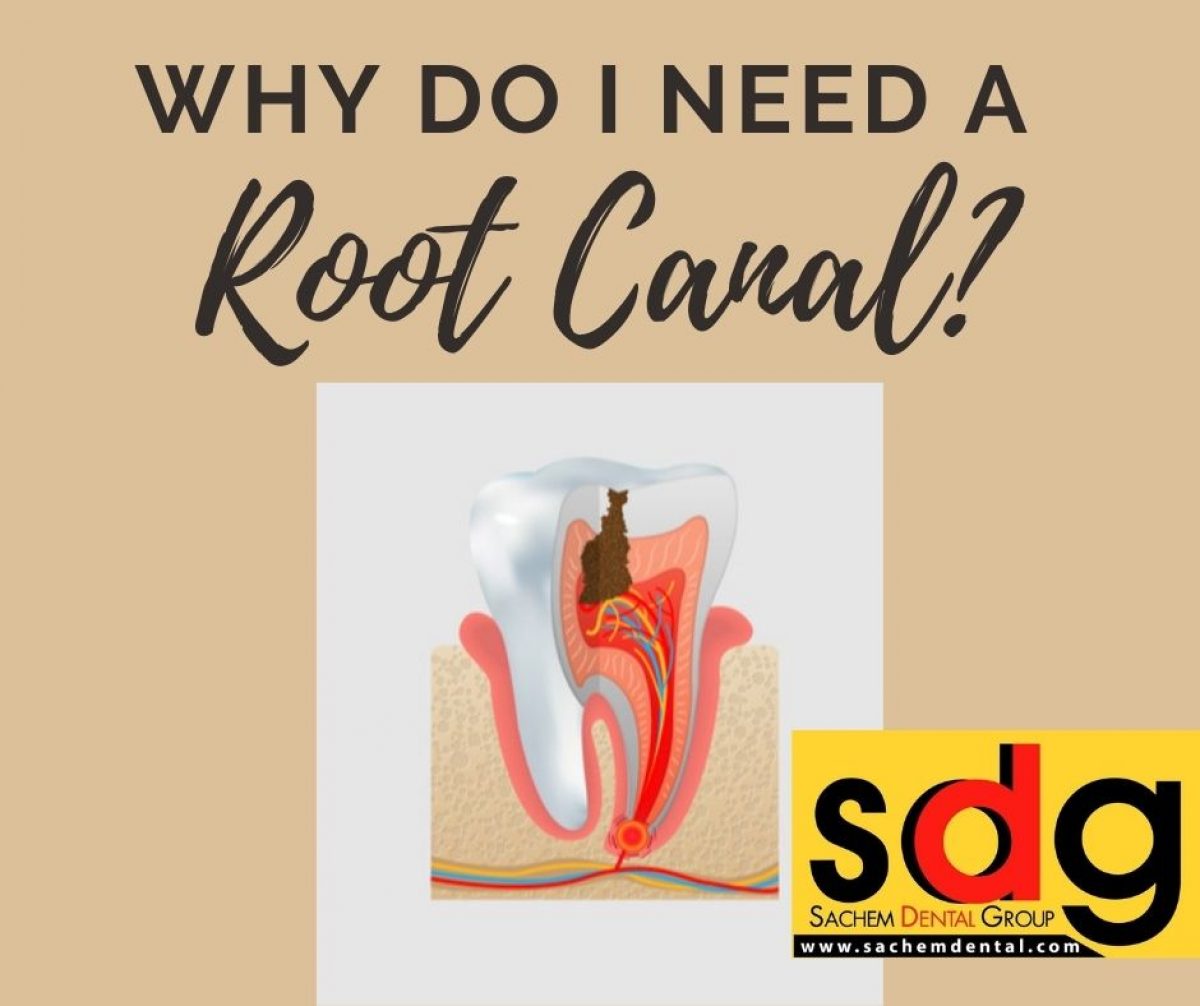 Why Do I Need a Root Canal if My Tooth Doesn’t Hurt? Sachem Dental Group