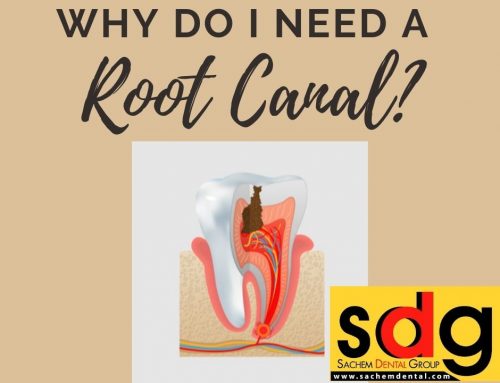 Why Do I Need a Root Canal if My Tooth Doesn’t Hurt?