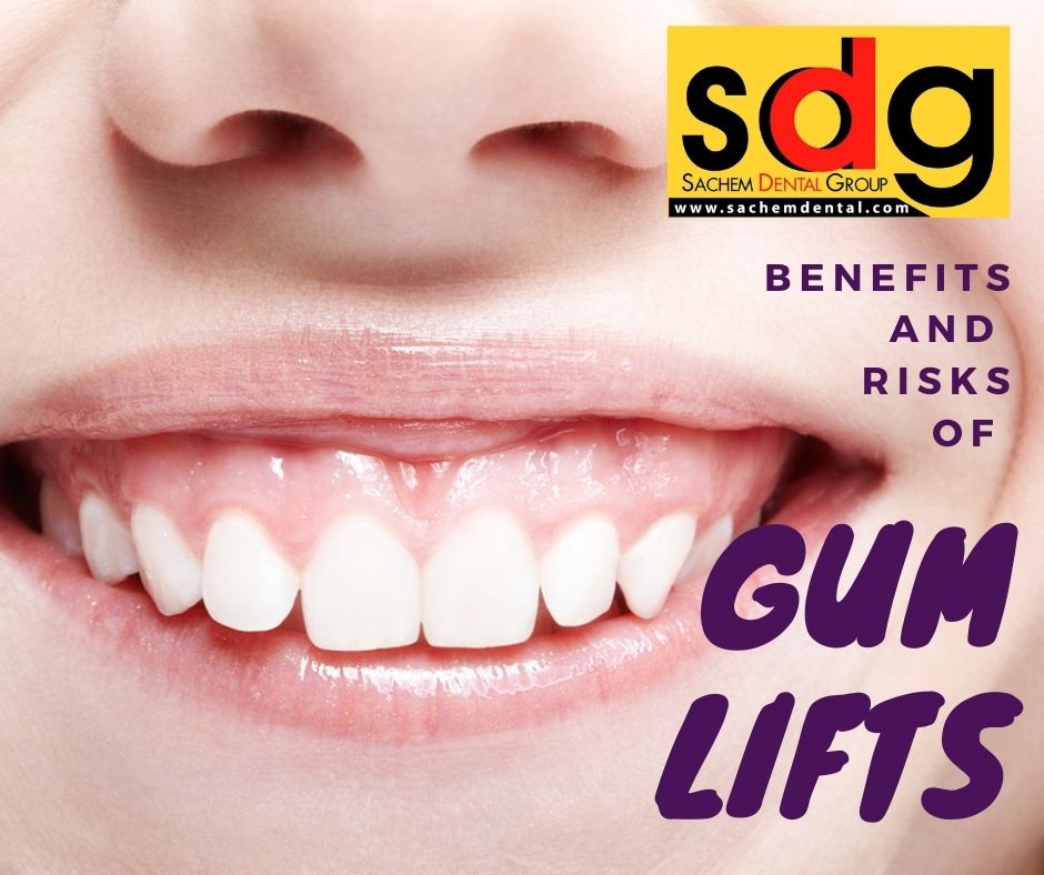 pros and cons of gum recontouring