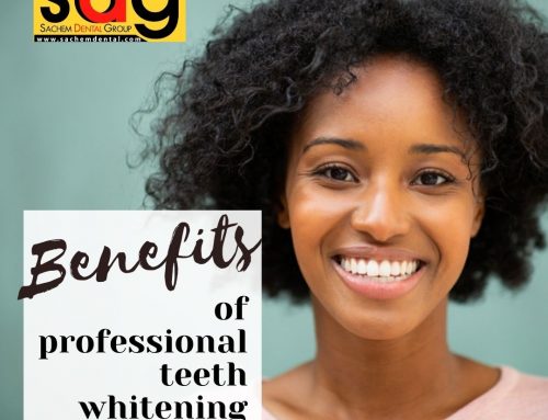 Teeth Whitening – Perks of Professional Treatment