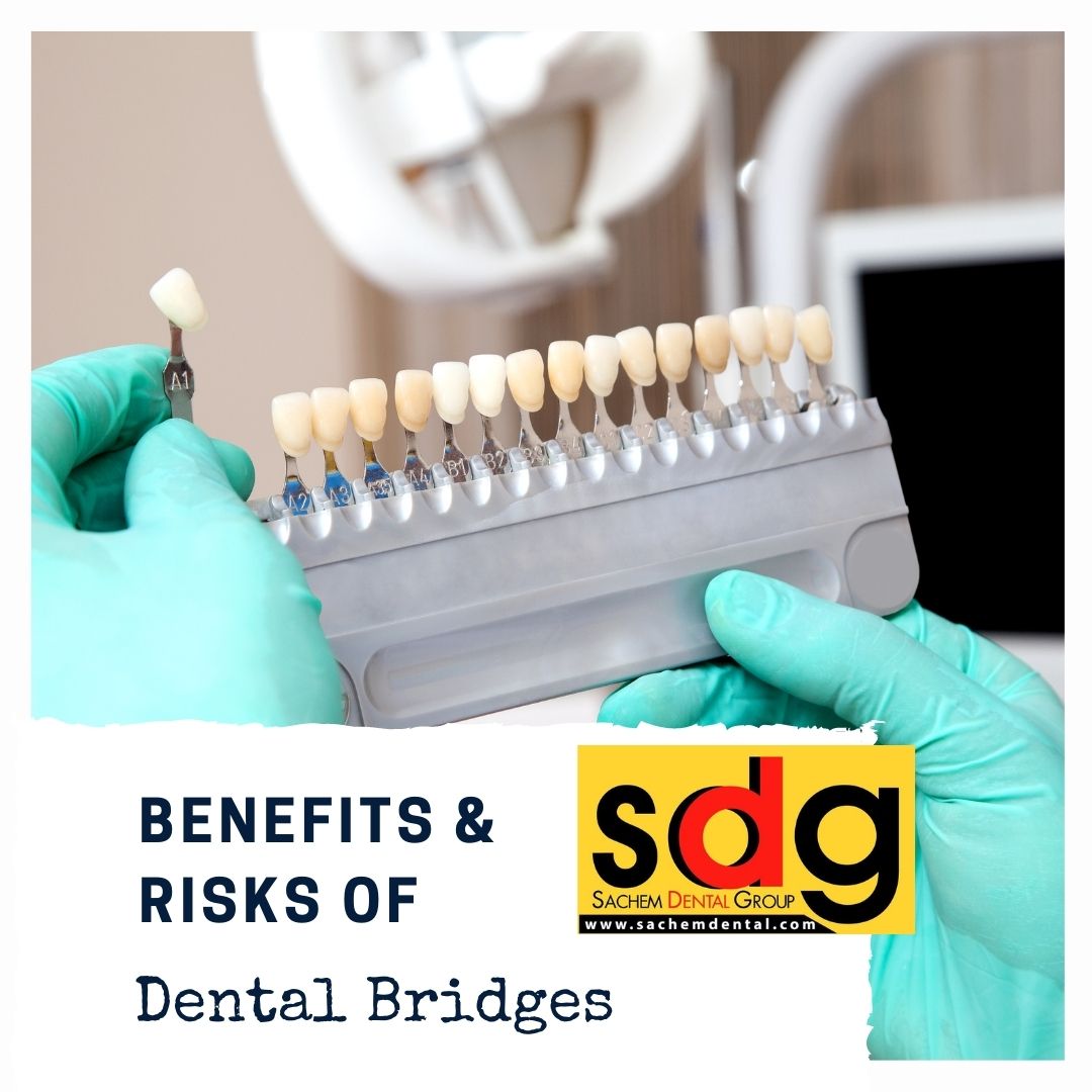 pros and cons of dental bridges