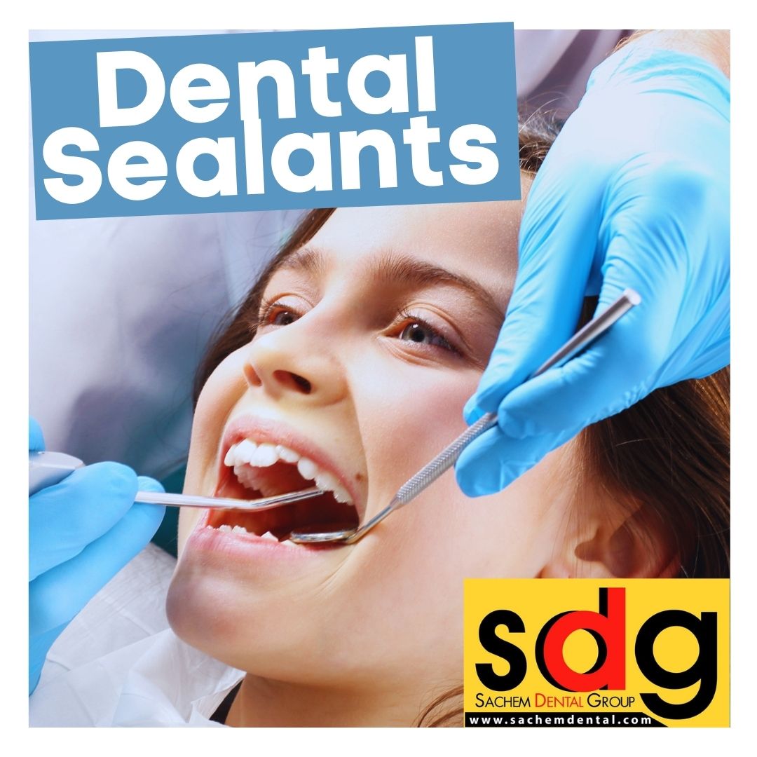 dental sealants in Long Island