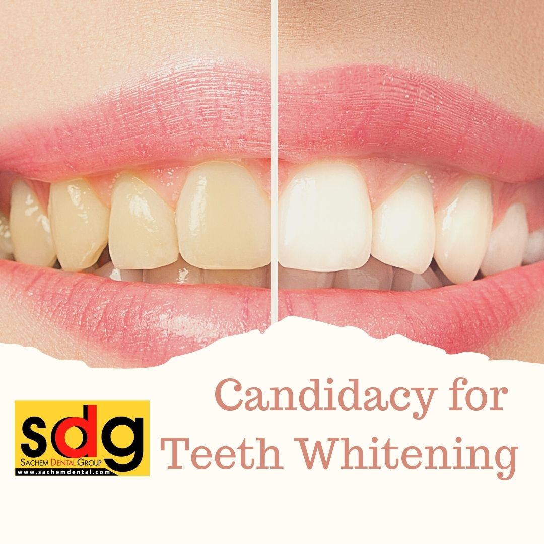 Do I qualify for teeth whitening?