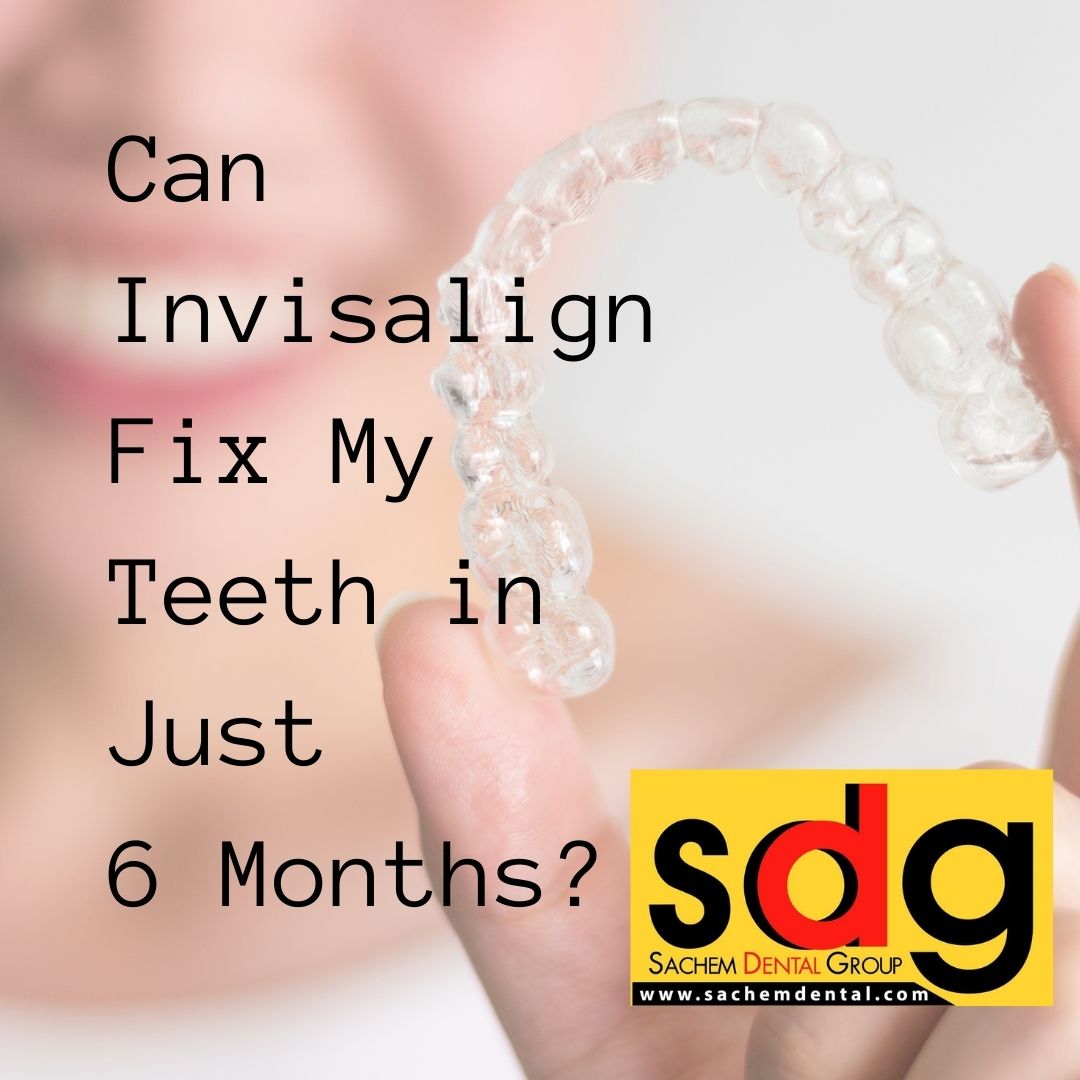 fast Invisalign treatment