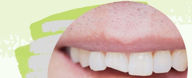 should I get dental bonding