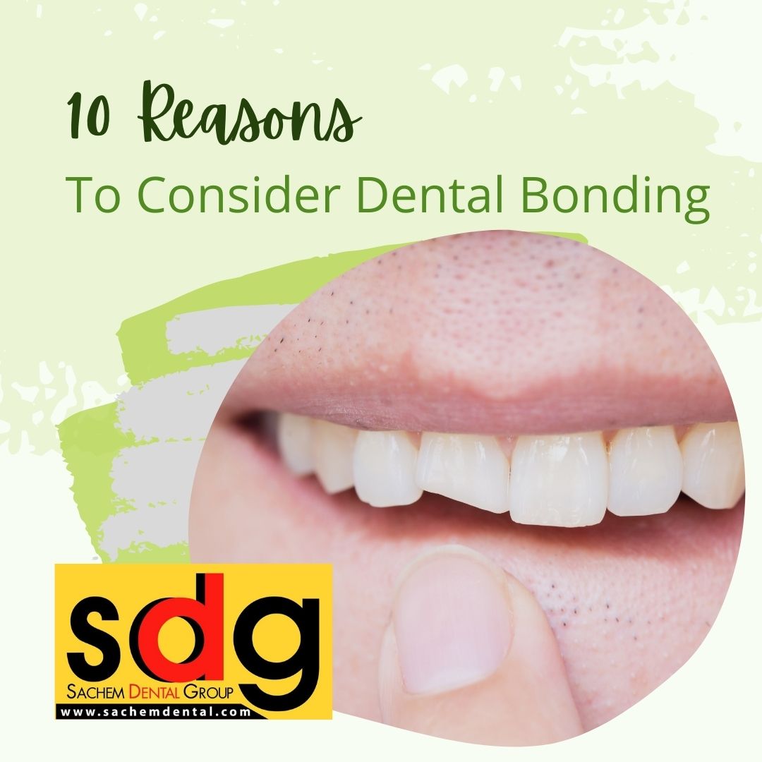 should I get dental bonding