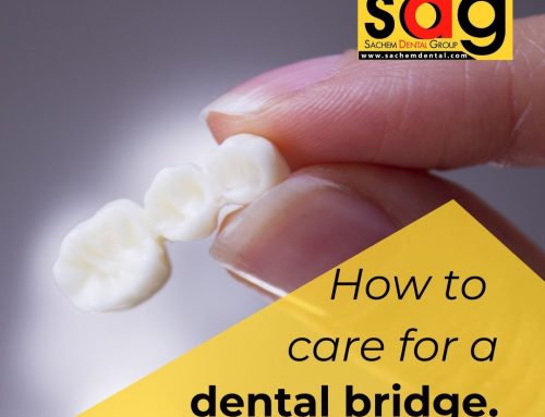 How To Care For My Dental Bridge