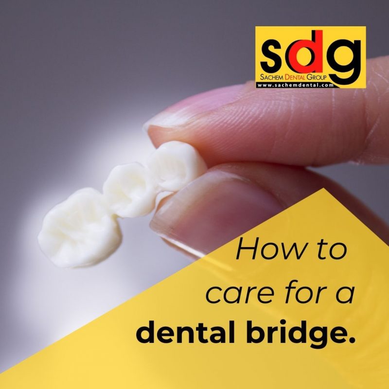 post dental bridge care