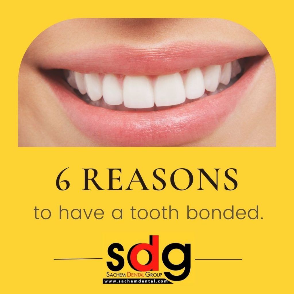 Dental Bonding 6 Reasons to Get a Tooth Bonded Sachem Dental Group