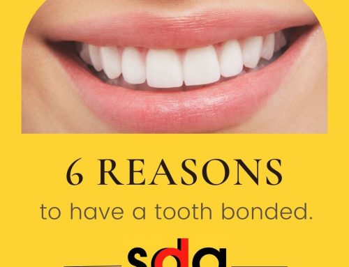 Dental Bonding: 6 Reasons to Get a Tooth Bonded