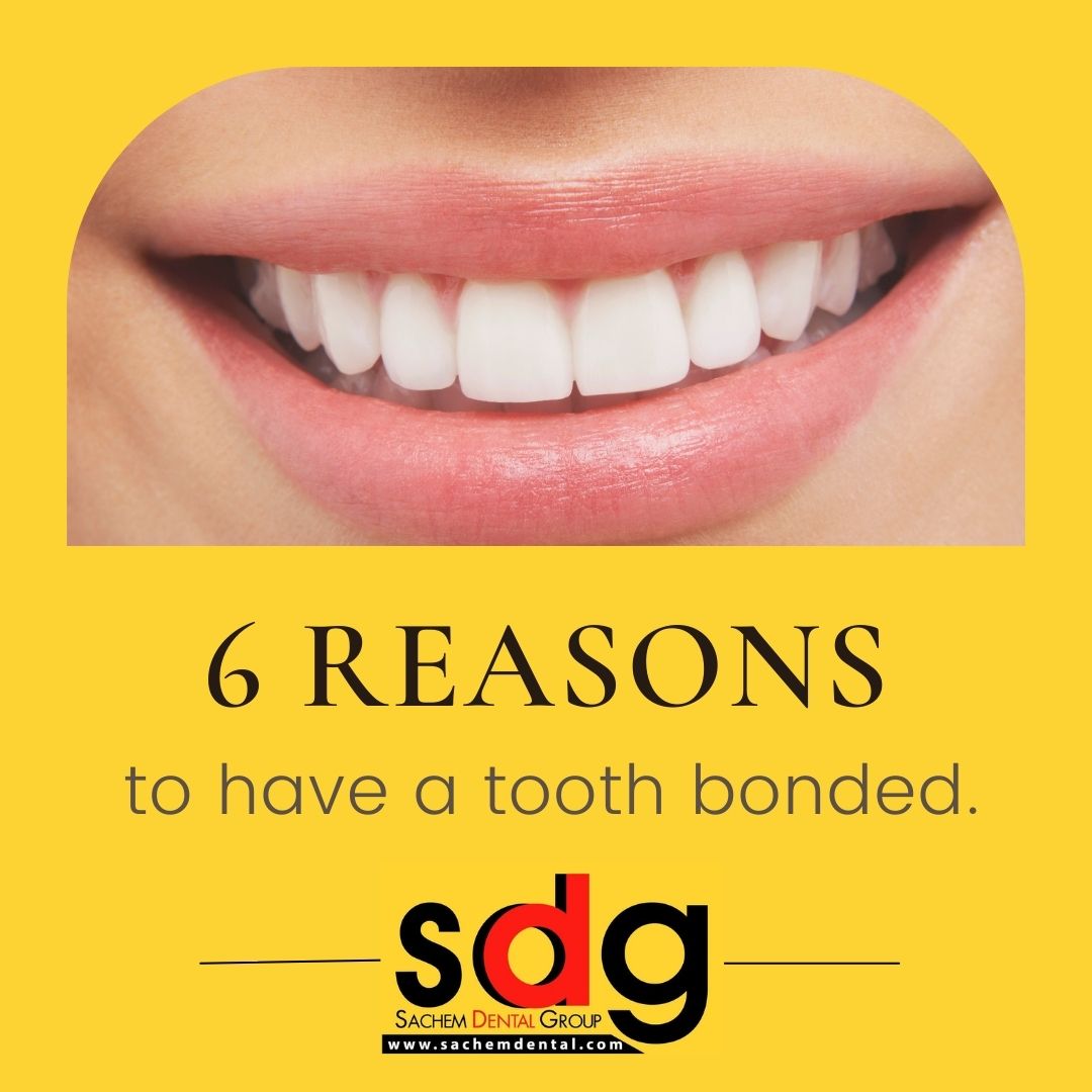 reasons for dental bonding