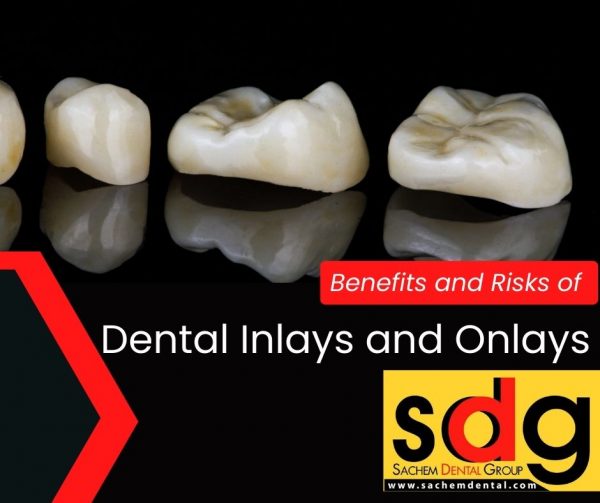 Inlays and Onlays Benefits and Risks Sachem Dental Group