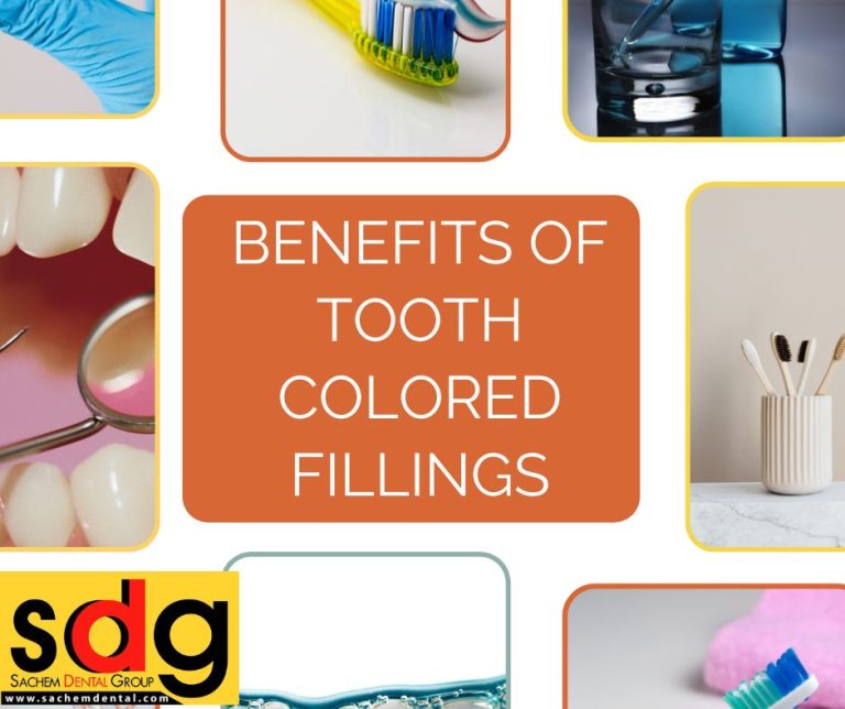 Benefits of ToothColored Fillings Sachem Dental Group
