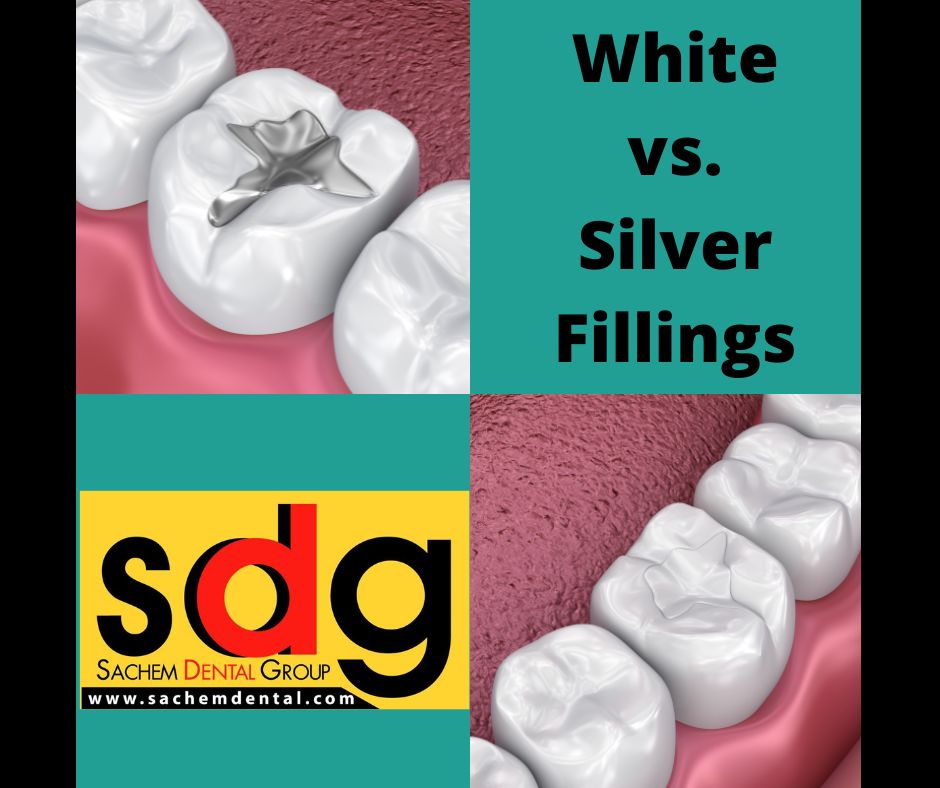 silver vs. white fillings