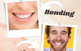 bonding vs. crowns