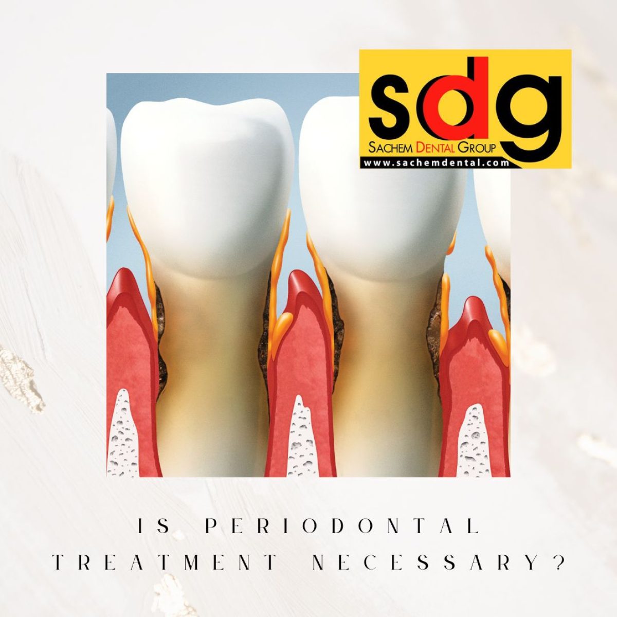 Is Periodontal Treatment Necessary? Sachem Dental Group