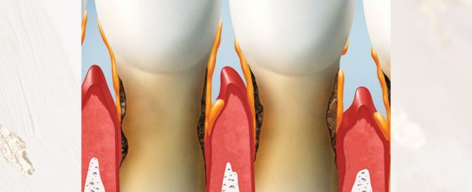 do i need periodontal therapy