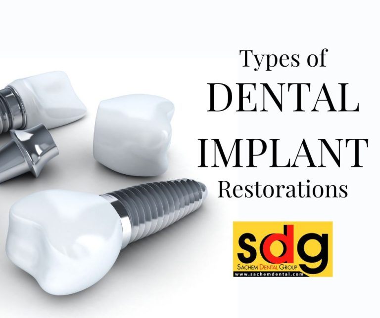 Dental Implant Restorations Types Of Tooth Replacement Sachem Dental Group