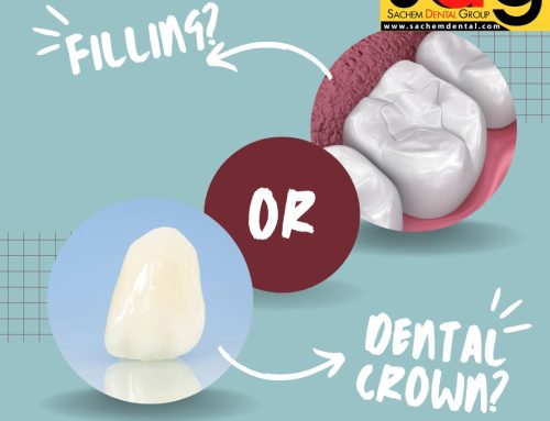 Is it Better to Get a Filling or a Crown?
