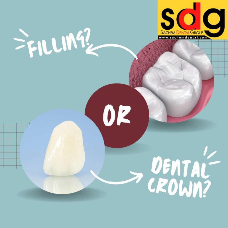 Is it Better to Get a Filling or a Crown? Sachem Dental Group