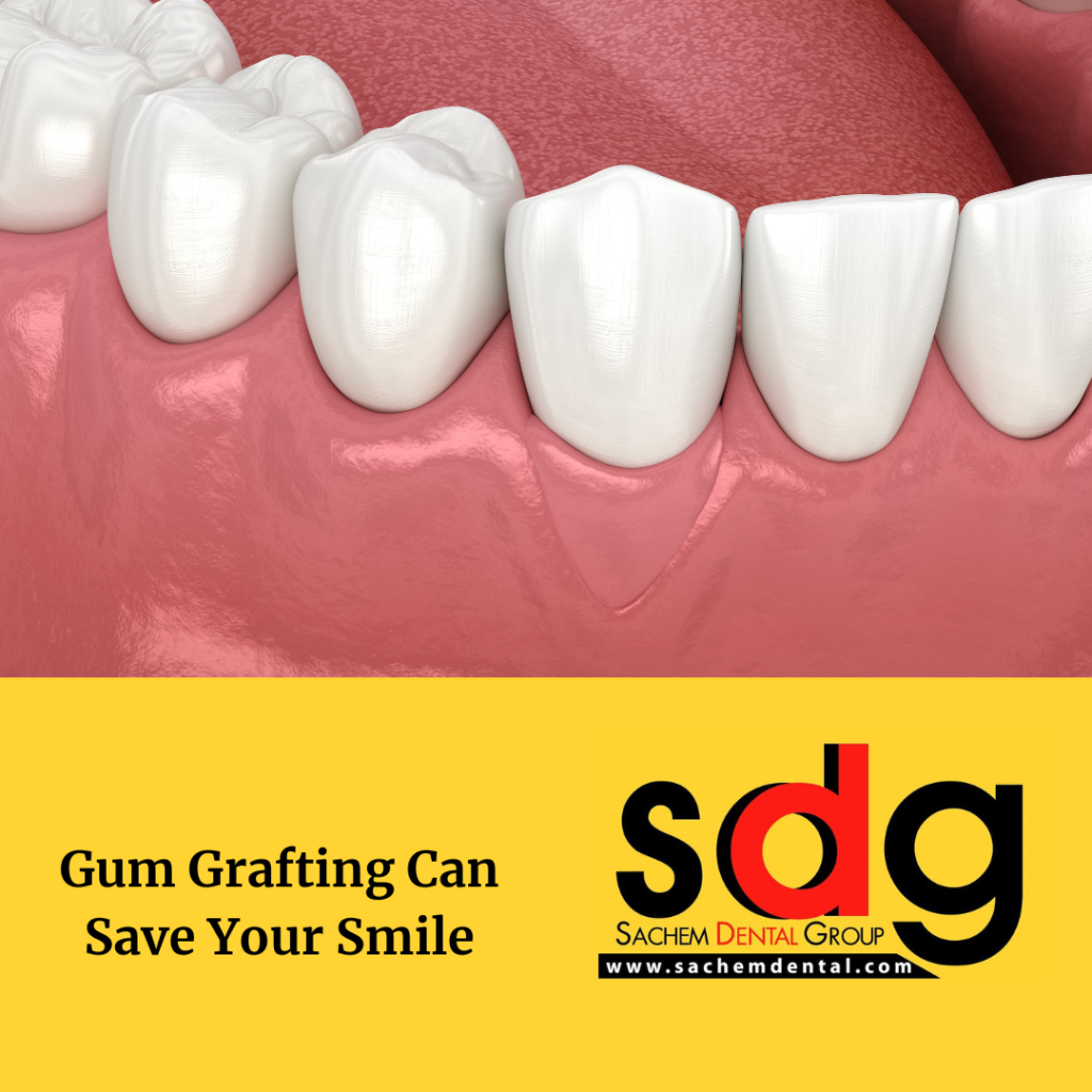 Cost of Soft Tissue Grafting Sachem Dental Group