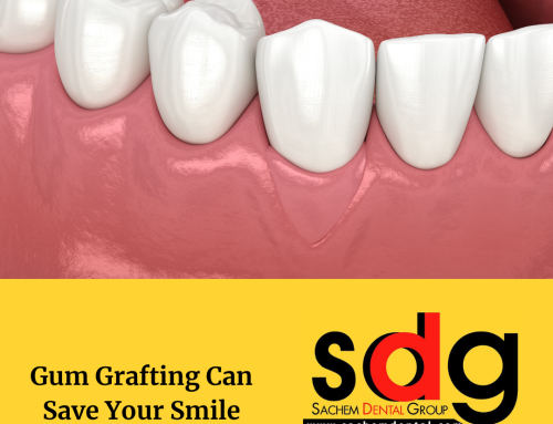 Cost of Soft Tissue Grafting
